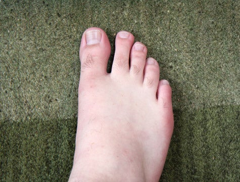 Toenails Regenerating