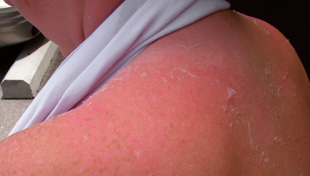 The Onion's Tips For Treating A Sunburn