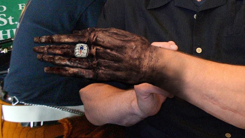 Patriots Horrified After New Super Bowl Rings Cause Fingers To Shrivel Up, Turn Black