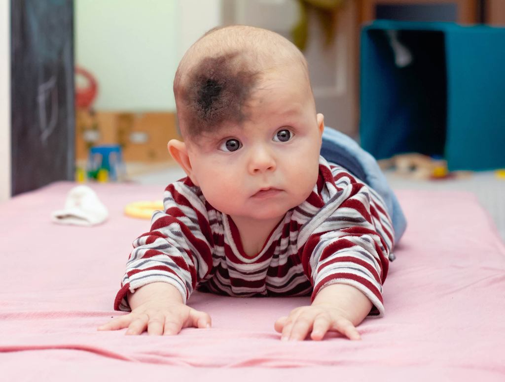 Mysterious Necrotic Skin Disease Continues To Eat Away At Baby’s Face Weeks After Being Kissed By Ted Cruz