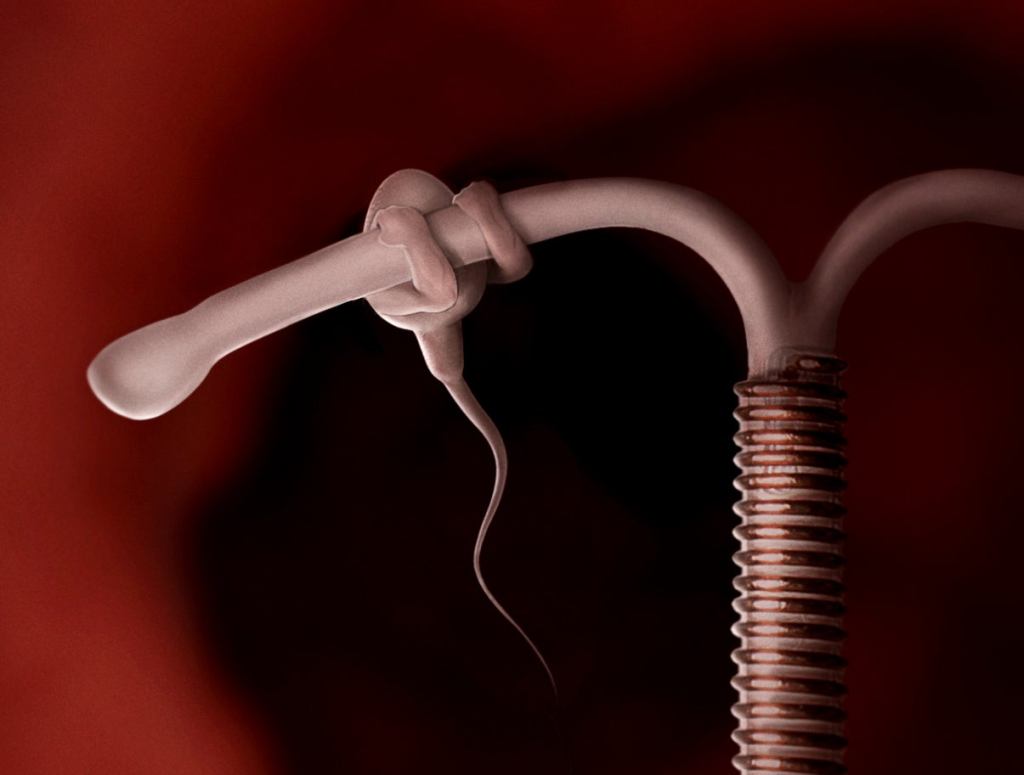 Extra-Strong Sperm Uses IUD As Pull-Up Bar