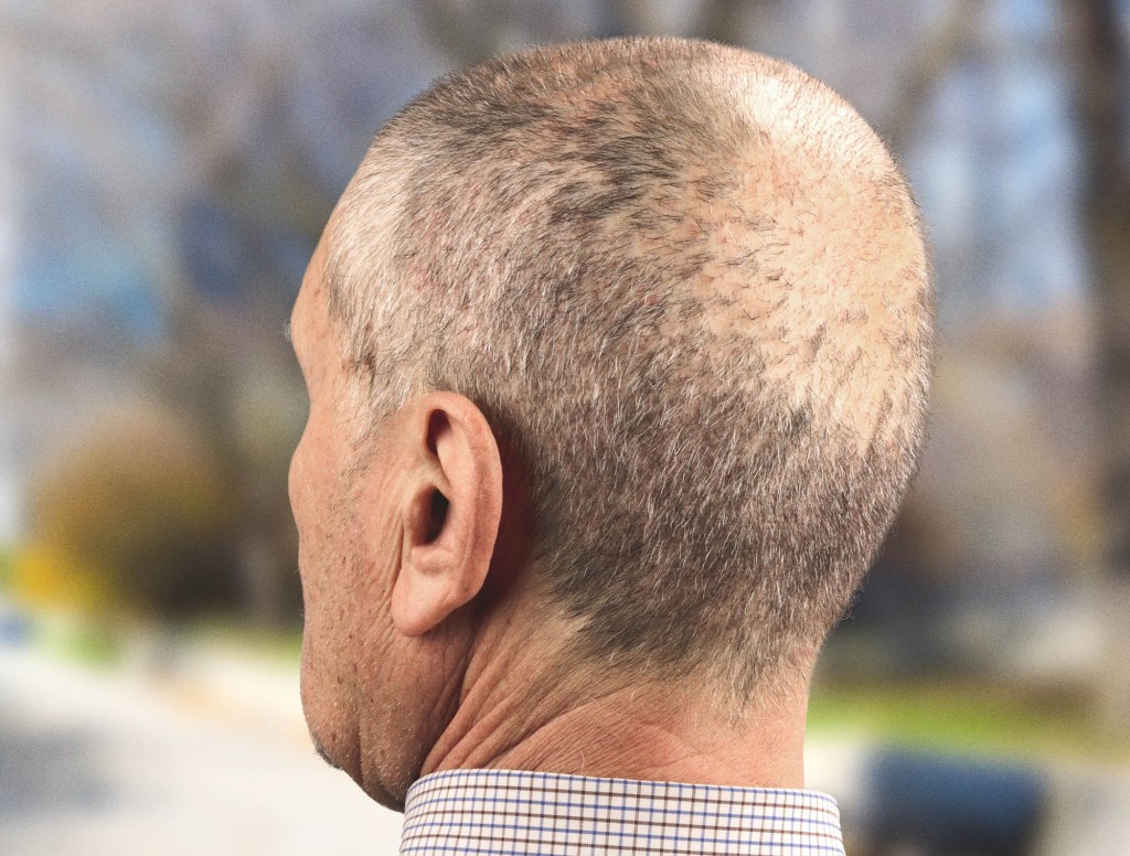 Bald Patch Must Be Spot Where Dog Keeps Pissing On Head